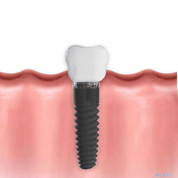 Int J Oral Maxillofac Implants：EB<font color="red">病毒</font>是否會(huì)影響種植體周圍炎的發(fā)生？