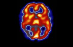 BMJ：偏头痛大幅增加主要<font color="red">心脑血管</font>疾病风险