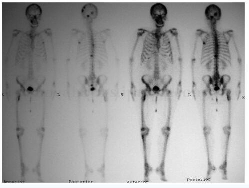 全身多发性骨转移癌 还需多学科通力合作