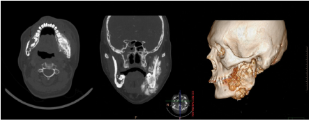 下颌骨骨肉瘤伴对侧骨髓炎1例