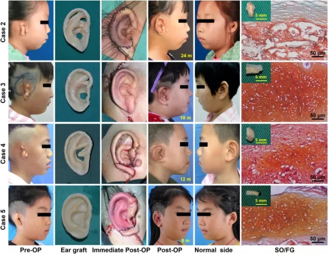 上海交大用3D打印 为5名儿童再造<font color="red">耳朵</font>