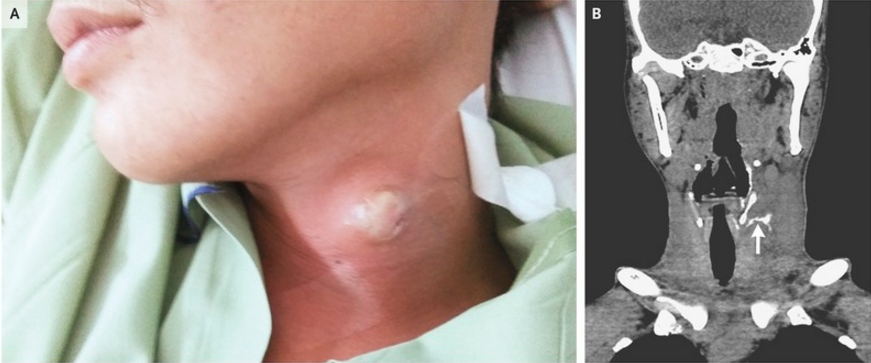 NEJM：复发性颈部脓肿的鳃裂窦-病例报道