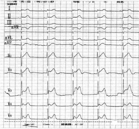<font color="red">10</font>岁患者频发室颤，心电图显示高猝死风险