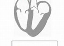 Eur Heart J-Card Img：心脏CT和经食管超声心动图检测感染<font color="red">性</font>心内膜炎，哪家强？