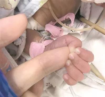 手术中，早产宝宝突然抓住医生手指
