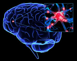 Neurology：脑出血周围水肿峰值与功能预后相关！