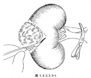 UROLOGY：<font color="red">肿瘤</font>接触表面积与部分<font color="red">肾</font>切除术患者术后肾功能的关系