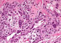 J Thorac Oncol:肺癌胸腔积液细胞PD-<font color="red">L</font>1表达是肺癌患者免疫治疗的预后指标吗？
