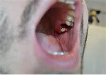 J Endod：下颌第一磨牙远舌根的存在与具有复杂根管形态的下颌<font color="red">中切牙</font>相关联