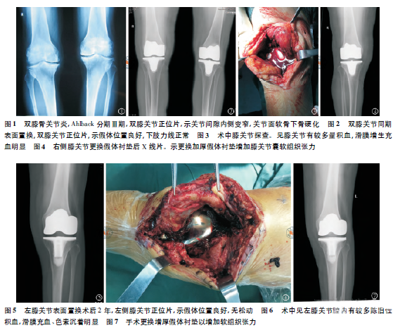 人工膝关节置换术后晚期自发性膝关节出血2例