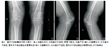 膝关节表面置换术后髌韧带断裂1例