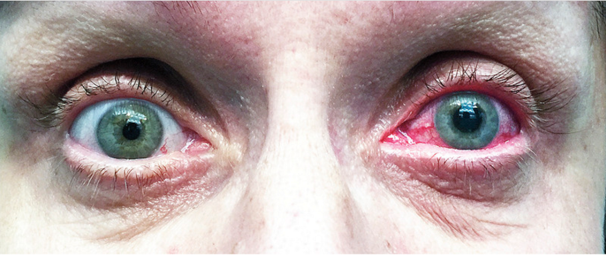 NEJM：急性闭角型青光眼-病例报道