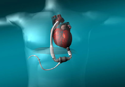 新研究：心脏的活体补丁