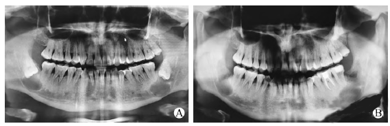 急性牙髓炎1例