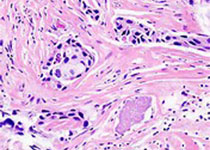 Sci Tran Med：科学家发现治疗乳腺癌失败的又一大因素