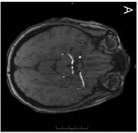 Neurology：心脏乳头状纤维弹性组织瘤致脑栓塞