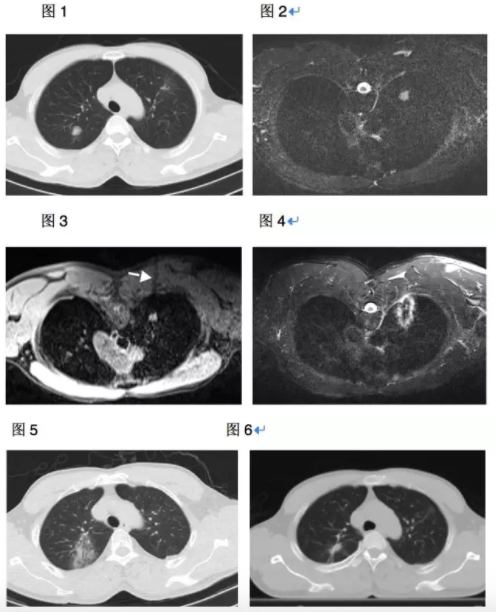 病例分享：MRI引导下<font color="red">肺</font>肿瘤热消融治疗是中晚期肺癌患者的有效治疗选择