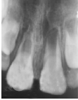 年轻恒牙伴牙根内吸收根尖诱导成形术1例