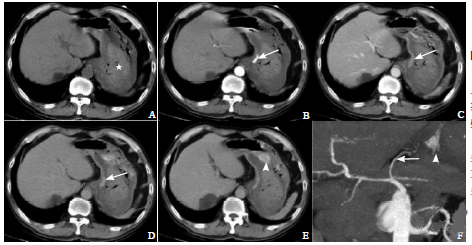 急性消化道出血的CT表现2例