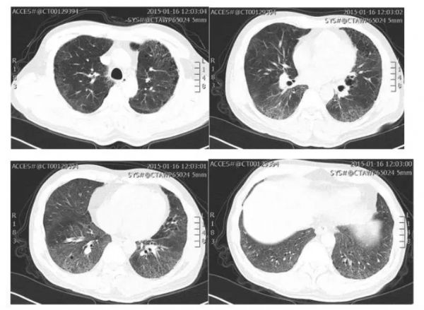病例分享：这例曾被误诊的肺间质疾病患者为何被称为典型？哪些相关检查易被忽略？