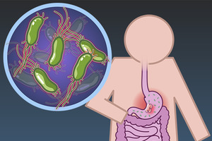 NEJM：幽门螺杆菌根除可大幅降低异时性胃癌风险