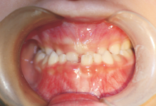 非综合征型先天性多数牙缺失母女2例