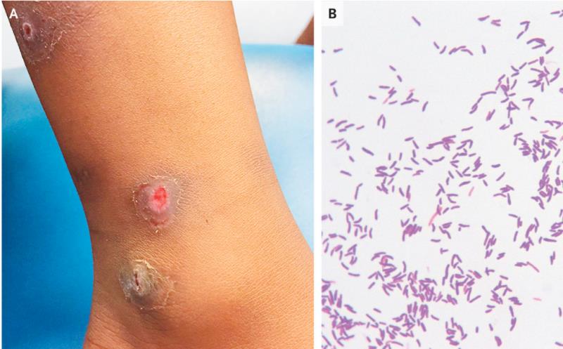 NEJM：皮肤<font color="red">白喉</font>-病例报道