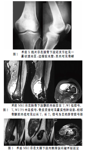 实用骨科杂志：左股骨放疗后骨坏死合并病理性骨折1例