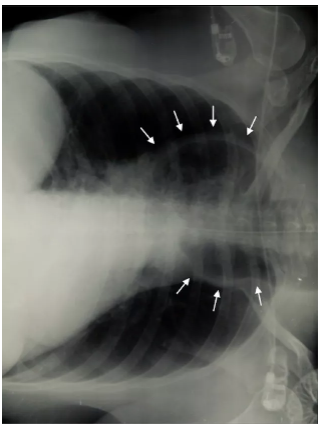 ICM：食管扩张-压迫气管-急性呼吸衰竭一例