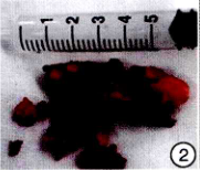<font color="red">鼻</font>内镜及内眦联合进路切除巨大筛窦骨瘤1例