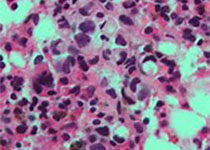 Stroke：肺癌合并脑卒中患者<font color="red">癌细胞</font>类型和<font color="red">细胞</font>外囊泡与凝血异常之间的关系！
