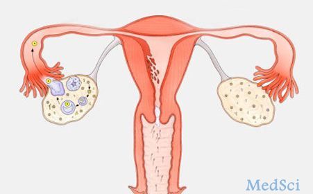 JCEM：局部皮质醇浓度升高导致多囊卵巢综合征患者的子宫内膜胰岛素抵抗