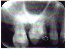 CBCT辅助诊断上颌第一磨牙双腭根伴副根管1例