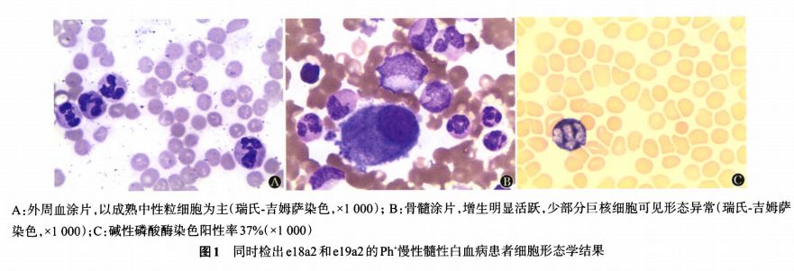 病例 | <font color="red">Ph</font>阳性髓性白血病BCR-ABL融合基因两种少见型报道