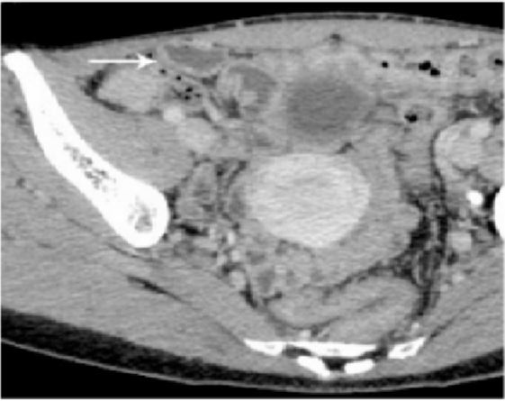 卵巢颗粒细胞瘤复发 PET -CT 检查假阴性1 例