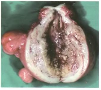 原发性子宫内膜样腺癌合并卵巢腺鳞癌1例