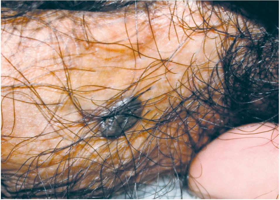 具有特殊皮肤镜表现的脂溢性角化病1例