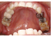 保留下颌第三磨牙的修复治疗1例