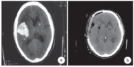 急性双侧半球脑出血手术3例