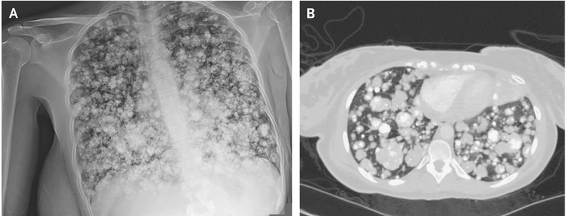 NEJM：软骨母细胞型骨肉瘤肺转移-病例报道