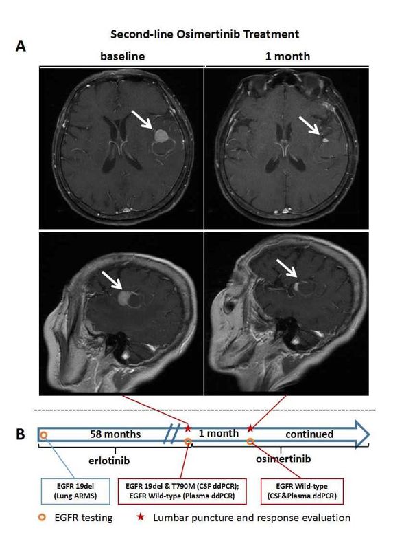 刘喆教授：肺癌脑实质转移患者，脑脊液EGFR突变检测可用于临床