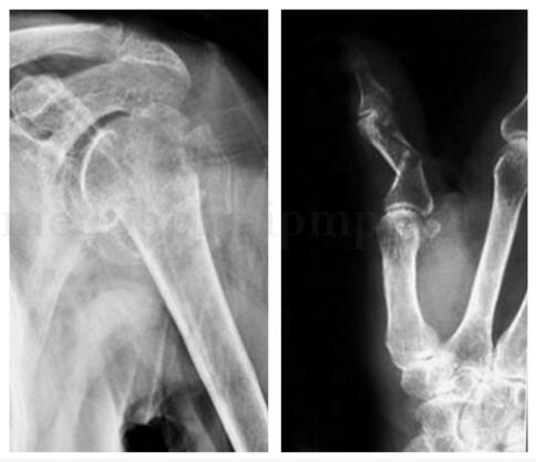 车祸伤及拇指 如何恢复掌指关节活动？