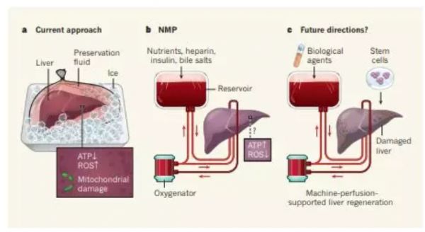 Nature：使用“生命支持系统”在体温下保存肝脏或可改善移植结果