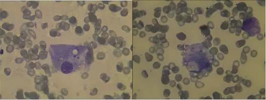 病例分享：一例典型的噬血细胞综合征报告