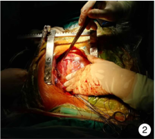 罕见介入术中非因冠脉破裂引发心包填塞经急诊抢救成功1例