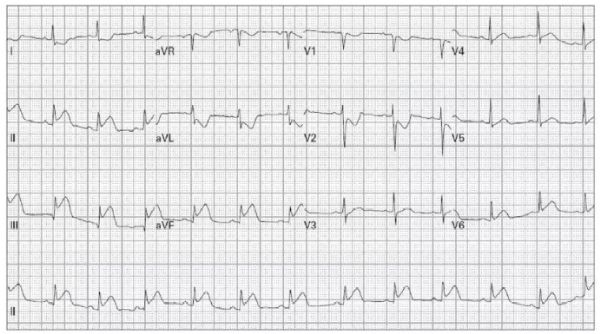 病例分享：右室心肌梗死的心电图表现