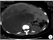 成人肝脏巨大未分化胚胎性肉瘤一例