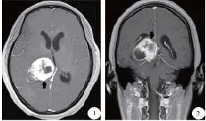 幕上及椎管内原始神经外胚层肿瘤1例