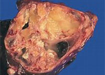 重达60公斤 一女性摘除有记载以来最大卵巢肿瘤