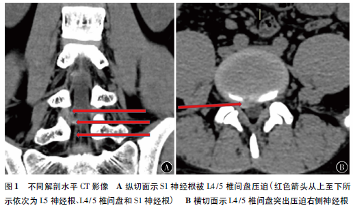 S1神经根变异的<font color="red">L4</font>/<font color="red">5</font><font color="red">椎间盘</font>突出症一例